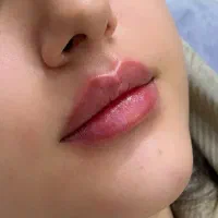 تزریق تخصصی فیلر لب نچرال توسط پزشک