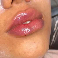 آموزش تخصصی ژل وبوتاکس و مزوتراپی توسط متخصص