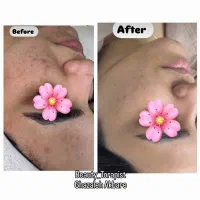 پاکسازی و جوانسازی پوست . هایفو صورت و غبغب|خدمات آرایشگری و زیبایی|مشهد, سجاد شهر|دیوار