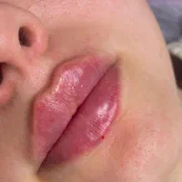 جشنواره ژل و فیلر لب/گونه/زاویه چانه800 در مطب|خدمات زیبایی و سلامت|اصفهان, شاهزید|دیوار