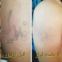 ریمو تتو.کربن ترابی صورت.روشن‌کردن نواحی تیره