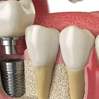 ایمپلنت  کره‌ای‌ 7900 /سوئیسی‌/ضمانت/کیفیت|خدمات آرایشگری و زیبایی|کرج, عظیمیه|دیوار