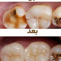 روکش دندان به صرفه و با کیفیت