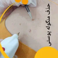 خالبرداری تخصصی بدون درد و بخیه در پادادشهر