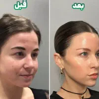 پلاژن تراپی صورت وبدن روشن سازی جوانسازی وابرسانی