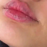 جشنواره تزریقات سی درصد تخفیف زیبایی تا یلدا