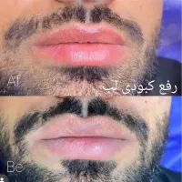 روشن سازی لب نچرال ، اسکالپ سر ، فیبروز ابرو نچرال