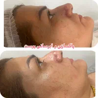 فیشال و نخ کلاژن به جای بوتاکس|خدمات آرایشگری و زیبایی|اصفهان, کوی ولی عصر|دیوار