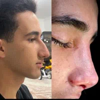 جراحی بینی/رینو پلاستی