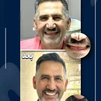 ایمپلنت دیجیتال