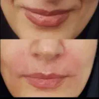 لیپو ساکشن ژل و بوتاکس کاشت مو مامایی اموزش