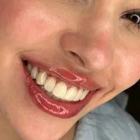 دندانپزشکی کامپوزیت و عصب کشی ( اقساطی )