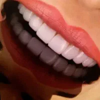 کامپوزیت دندان /عصب کشی /روکش /ترمیم