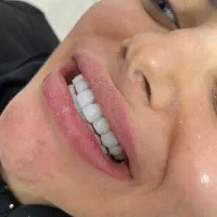 تخفیف کامپوزیت لمینت با اقساط|خدمات آرایشگری و زیبایی|قم, مهدیه|دیوار