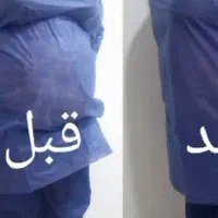 ساکشن چربی ،تزریق چربی ، تزریق ژل ،فیلر لب بلفارو|خدمات آرایشگری و زیبایی|خرم‌آباد, |دیوار