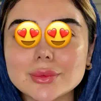 تزریق ژل فقط 750