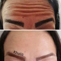تزریق چربی ، فیلر بادی، ژل، بوتاکس در مطب|خدمات آرایشگری و زیبایی|شیراز, گویم|دیوار