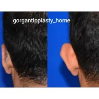 تیپ پلاستی نوک بینی با بی حسی بدون بیهوشی|خدمات آرایشگری و زیبایی|گرگان, |دیوار