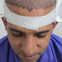 مرکز تخصصی کاشت موی طبیعی رویش طلایی مکران