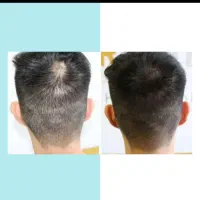 دکتر نانو رویش بدون جراحی