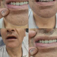 دندون بزار با قیمت استثنایی