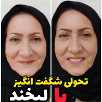 ساخت دندان مصنوعی طرح لمینت با قیمت اقتصادی|خدمات آرایشگری و زیبایی|یزد, |دیوار