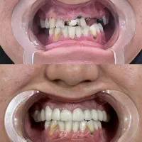 دندانپزشکی/کامپوزیت دیجیتال/ ایمپلنت/عصب کشی|خدمات آرایشگری و زیبایی|مشهد, ده دی|دیوار
