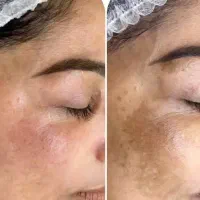 بامن تا شب عیدفقط با سه جلسه پوستی شفاف داشته باش