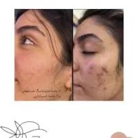 پاکسازی جوانسازی پوست و خالبرداری و مزو و بوتاکس|خدمات آرایشگری و زیبایی|سمنان, |دیوار