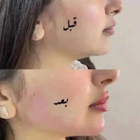 ژل و بوتاکس