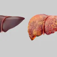 بهبود کبدچرب