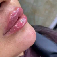 جشنواره  تابستانی ژل و بوتاکس بلفا ساکشن
