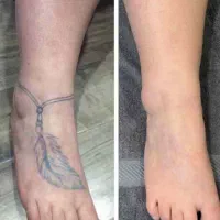 لیزر پاک کننده تاتو بدن و صورت(تضمینی)