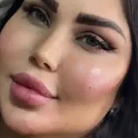 ژل و بوتاکس