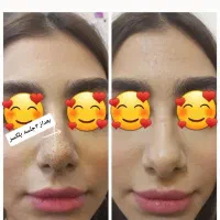 فیشیال (پاکسازی) خالبرداری و پلاسما صورت|خدمات آرایشگری و زیبایی|کوهدشت, |دیوار