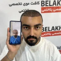 کاشت مو و ابرو طبیعی در تبریز + پرداخت چکی