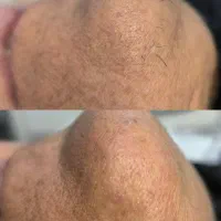 الکترولیز  تخصصی موهای سفید و ضخیم