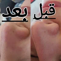 %30 تخفیف فیشال تخصصی پلاژن کربوسی اسیدومزونیدلینگ|خدمات آرایشگری و زیبایی|اهواز, کوی باهنر|دیوار
