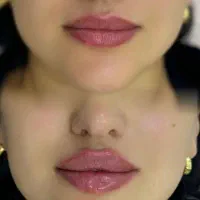 تخفیف ژل لب وکانتورینگ فیلربادی ،بوتاکس،لیفت نخ