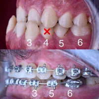 ارتودنسی فقط ۱۳ میلیون اقساط بدون چک.|خدمات زیبایی و سلامت|تهران, جردن|دیوار