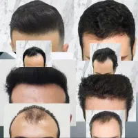 کاشت موی طبیعی با بالاترین تراکم