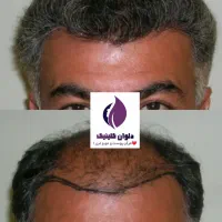 تخفیف پاییز تا یلدا کاشت مو و ابرو و مژه