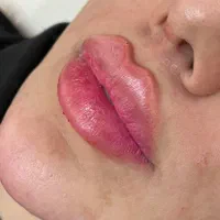 مدل بوتاکس و پی ار پی و کانتورینگ صورت با فیلر|خدمات آرایشگری و زیبایی|اصفهان, ملک‌شهر|دیوار