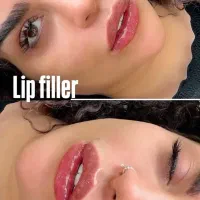 تزریق فیلر لب ۵ میلیون تومان