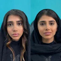 فیلر فول کانتور و زاویه سازی در کلینیک سپیداسکین