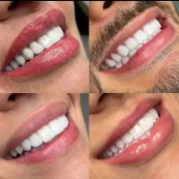 جشنواره عیدانه کامپوزیت دندان