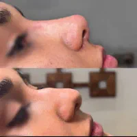 تخفیف ویژه کوچک کردن بینی،آنزیم غبغب، فیلر|خدمات آرایشگری و زیبایی|مشهد, آزادشهر|دیوار