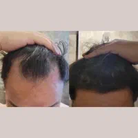 بدون عوارض کاشت نتیجه بگیر