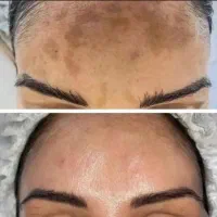 ضد لک بیوممتیک (تضمینی و بدون بازگشت)