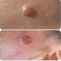 برداشتن انواع خال .میخچه .زیگل با لیزر